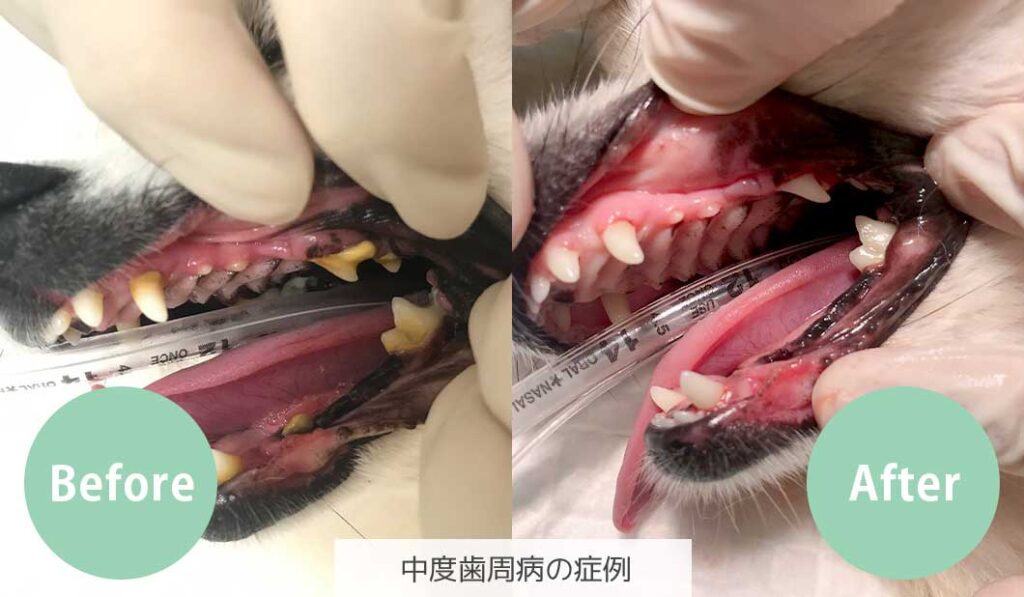 中度歯周病の症例